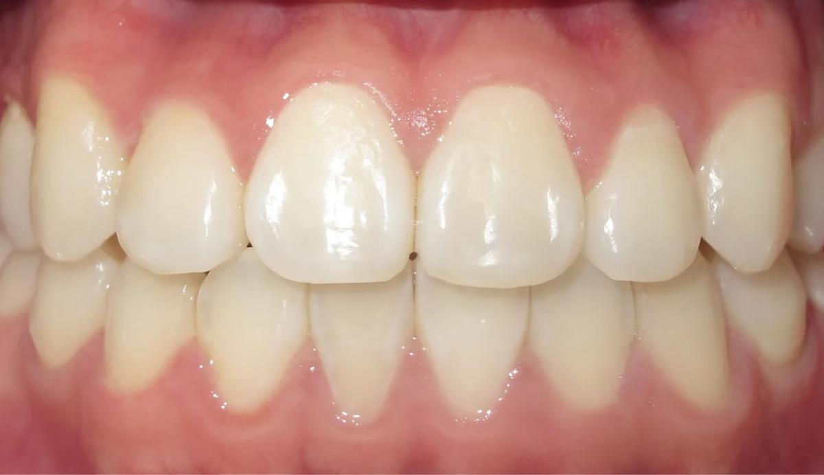 Patient smile after orthodontic treatment at Premier Orthodontics