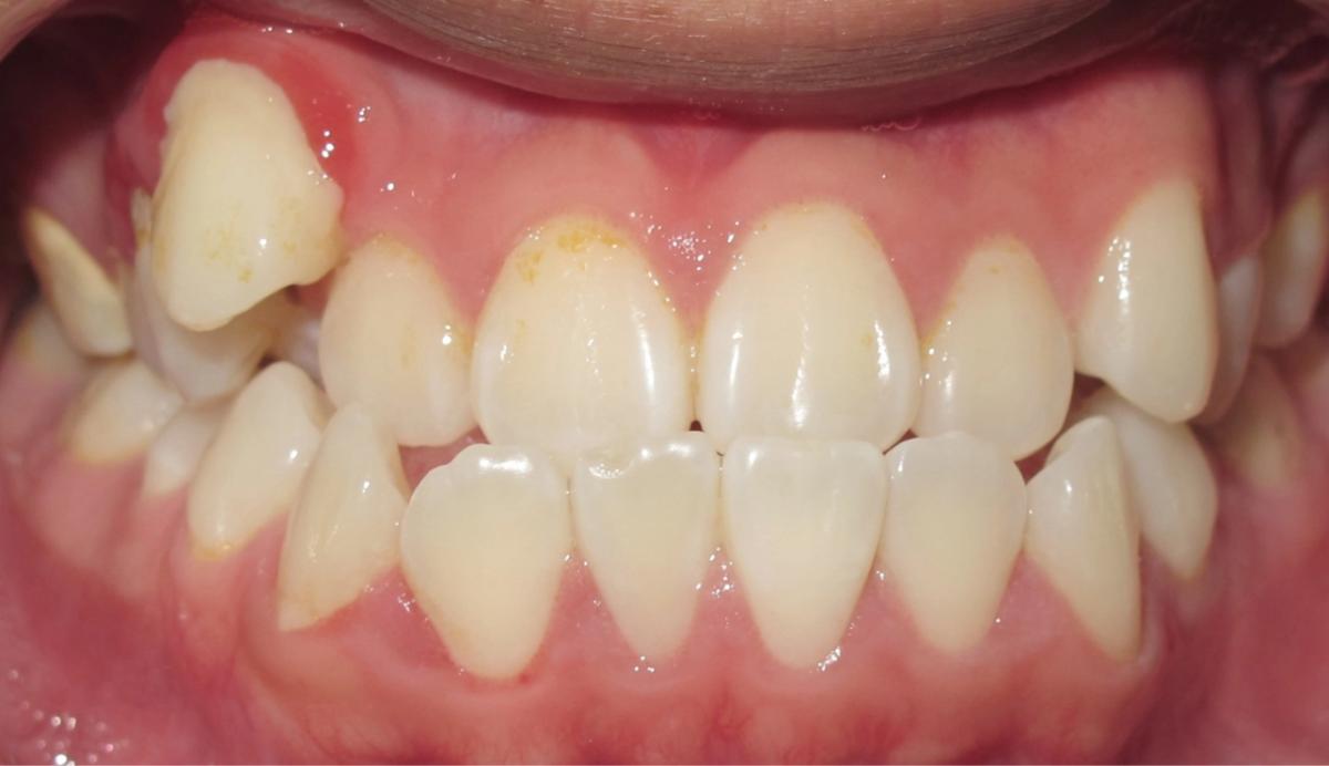 Patient smile before orthodontic treatment at Premier Orthodontics