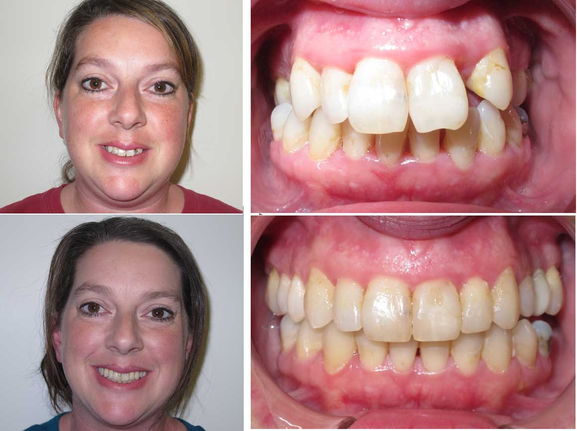 Can Invisalign® Fix Overbite: Before & After Results