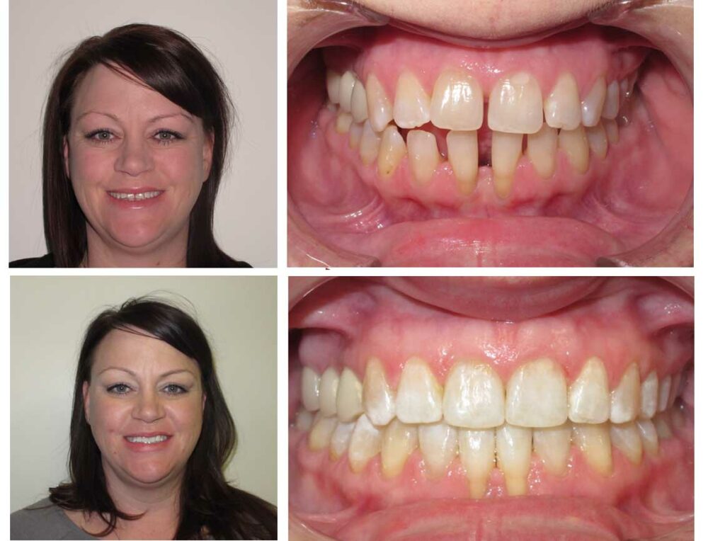 Fixing overbite of a real patient seeking treatment for cosmetic reasons