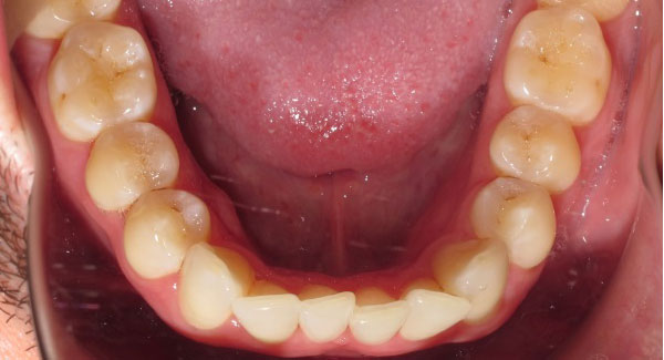 teeth shifting from not wearing a retainer