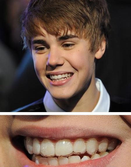 justin beiber wore invisalign aligners or Invisalign trays or clear aligners