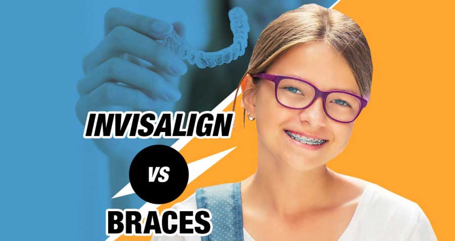 Braces vs Invisalign: Which one to Choose and Why?