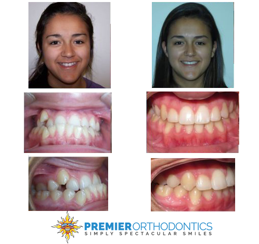 Actual patient of Premier Orthodontics, corrected with fixed braces