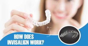 How does Invisalign work?