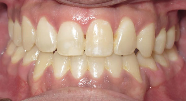actual patient of Premier Orthodontics