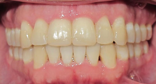How Long Do Braces Take