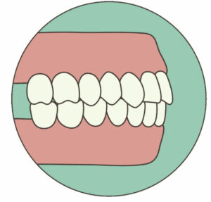 an example of a normal bite with the top teeth in contact with the bottom teeth and a good jaw alignment