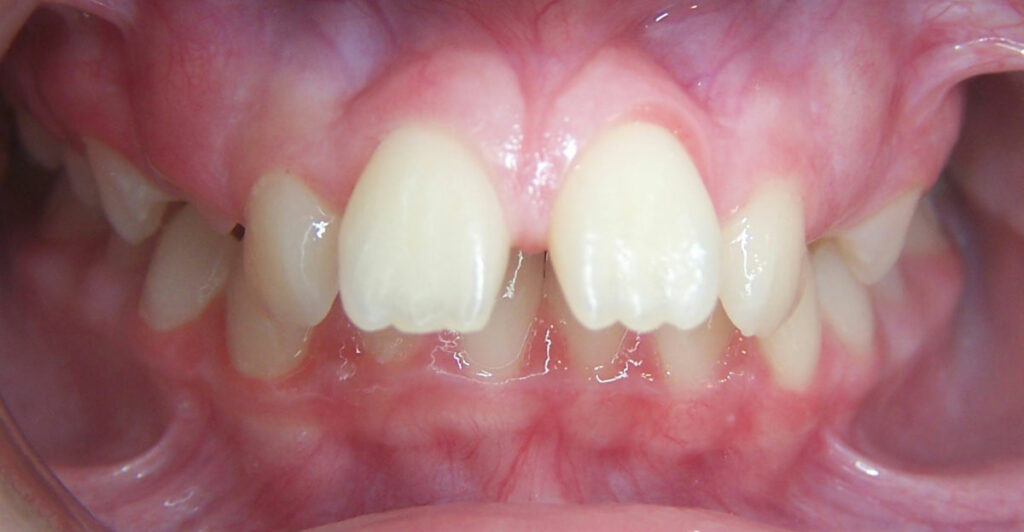Invisalign fix overbite. Front teeth stick out excessivly. Patient sought treatment of Invisalign for overbite