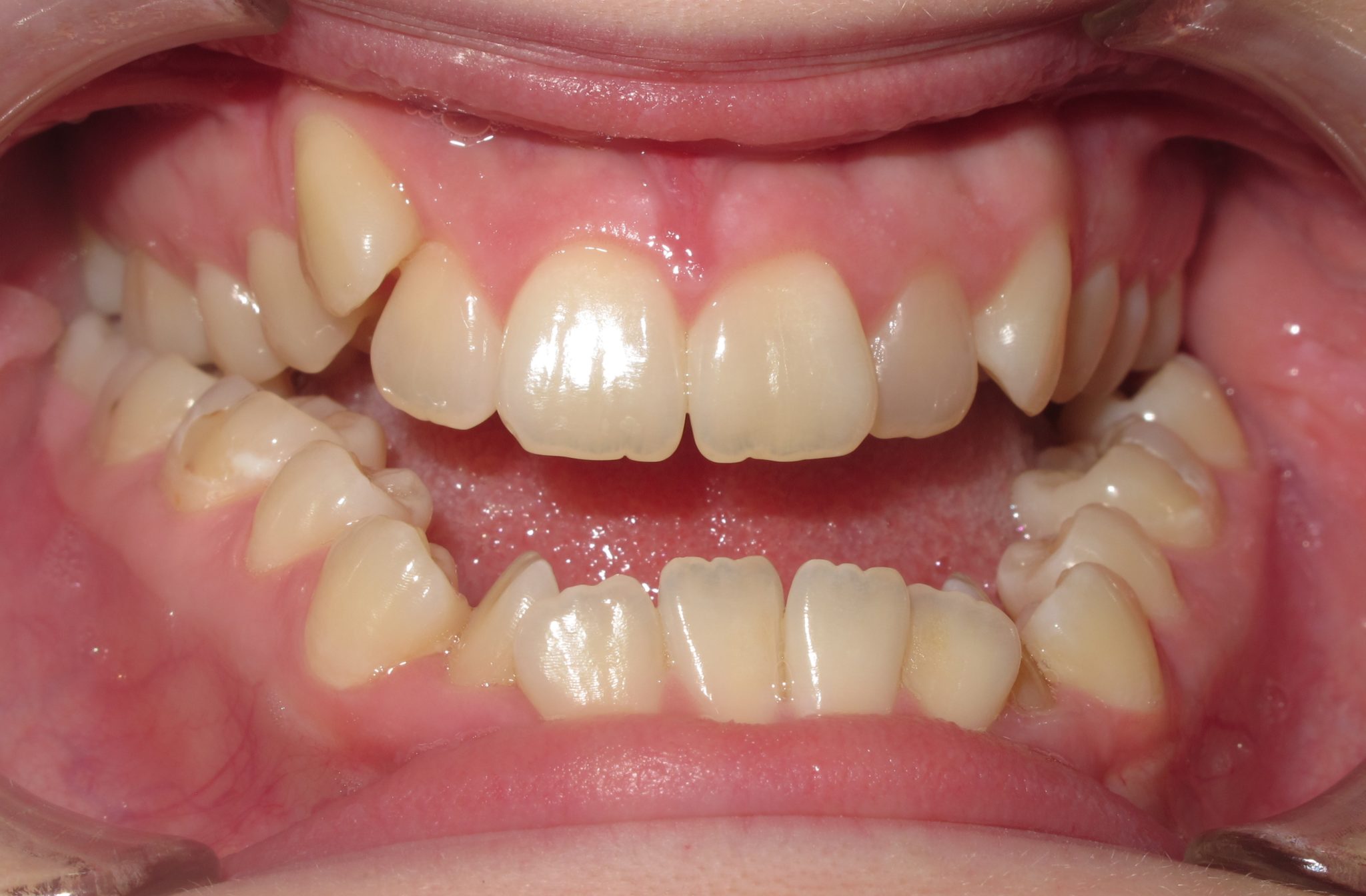 Can Braces Change Your Jawline?