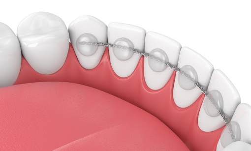 Permanent retainer bonded to each tooth