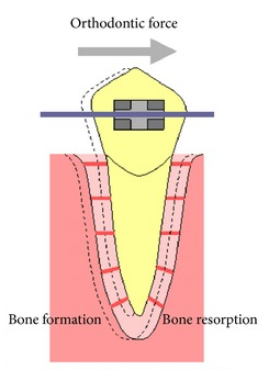 orthodontic tooth movement