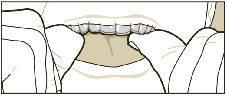 Clear retainer insertions