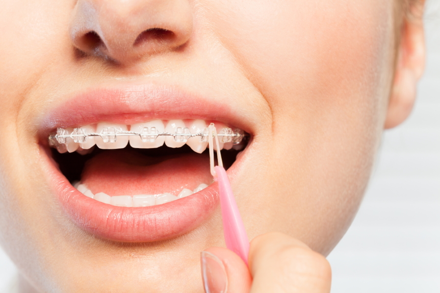 Using a plastic hook to place rubber bands on braces