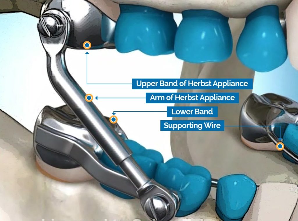 Herbst Appliance Diagram