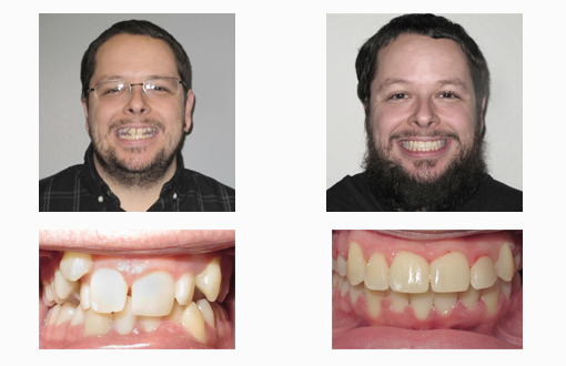 adult before and after clear braces