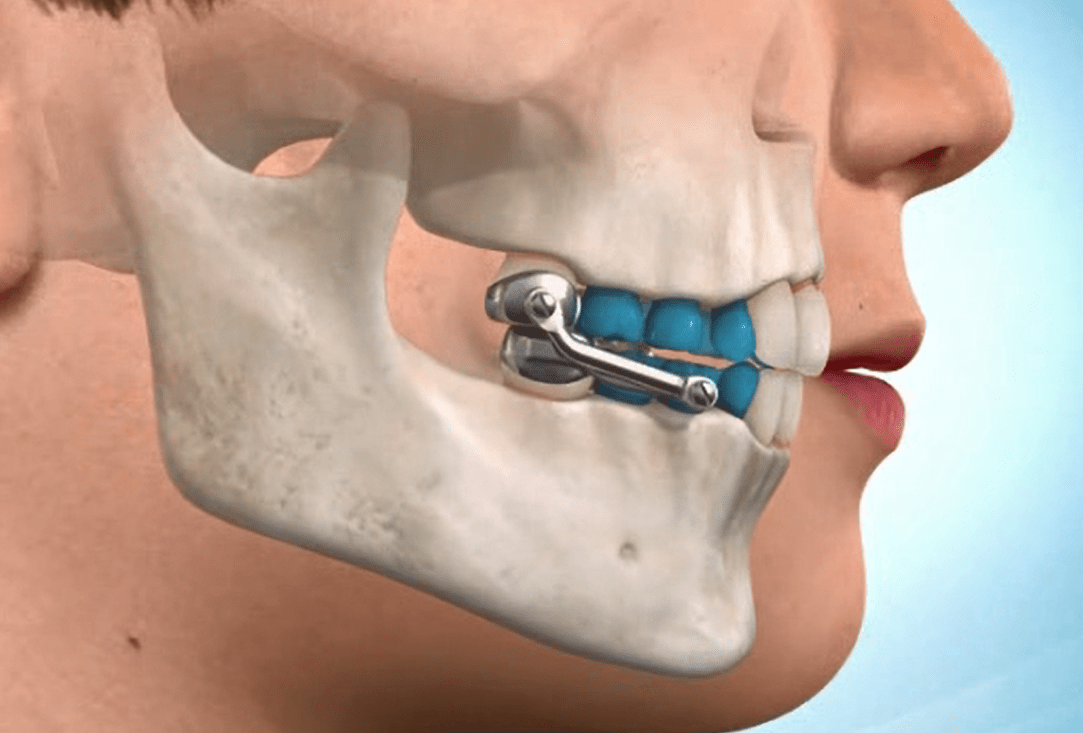 Overbite Correction Appliance Overbite Correction Appliance