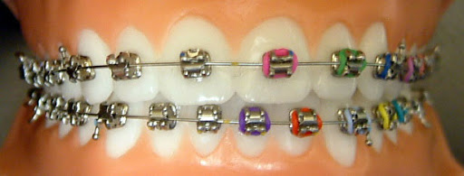 You can still place color on metal self ligating braces for decoration if you’d like!