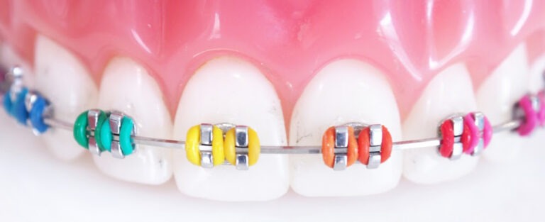 Self Ligating Braces What Are They Benefits And Costs 