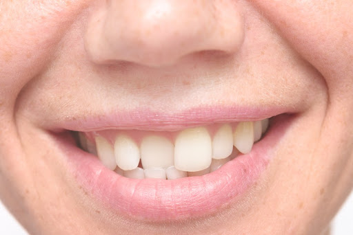 top teeth image