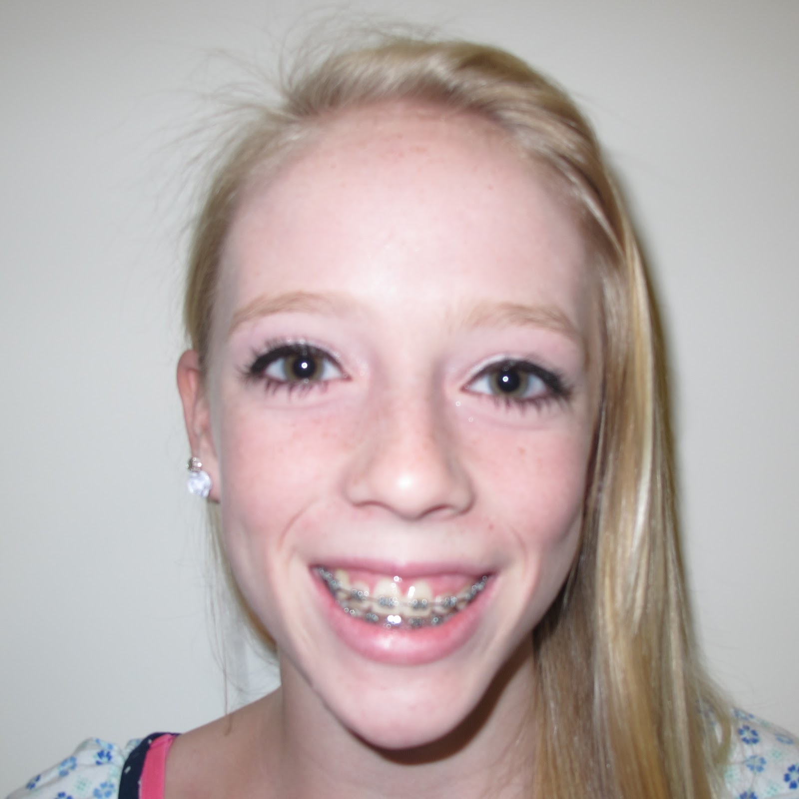 Overbite: Before & After Orthodontic Braces Treatment