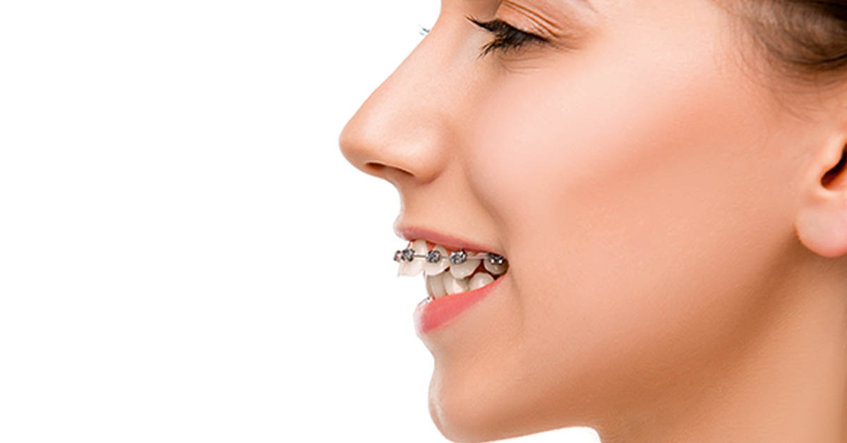 how do braces fix overbites