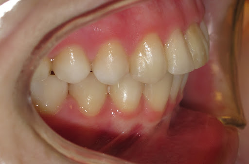 overbite after braces and rubber bands