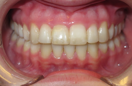 overbite after braces and rubber bands