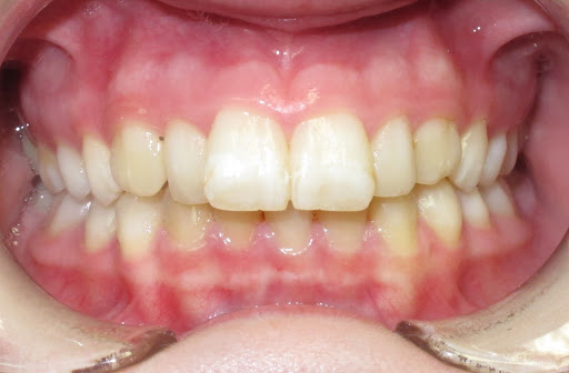 overbite before braces and rubber bands