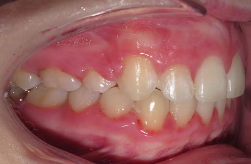 overbite after extractions and braces