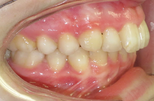 overbite before braces and rubber bands