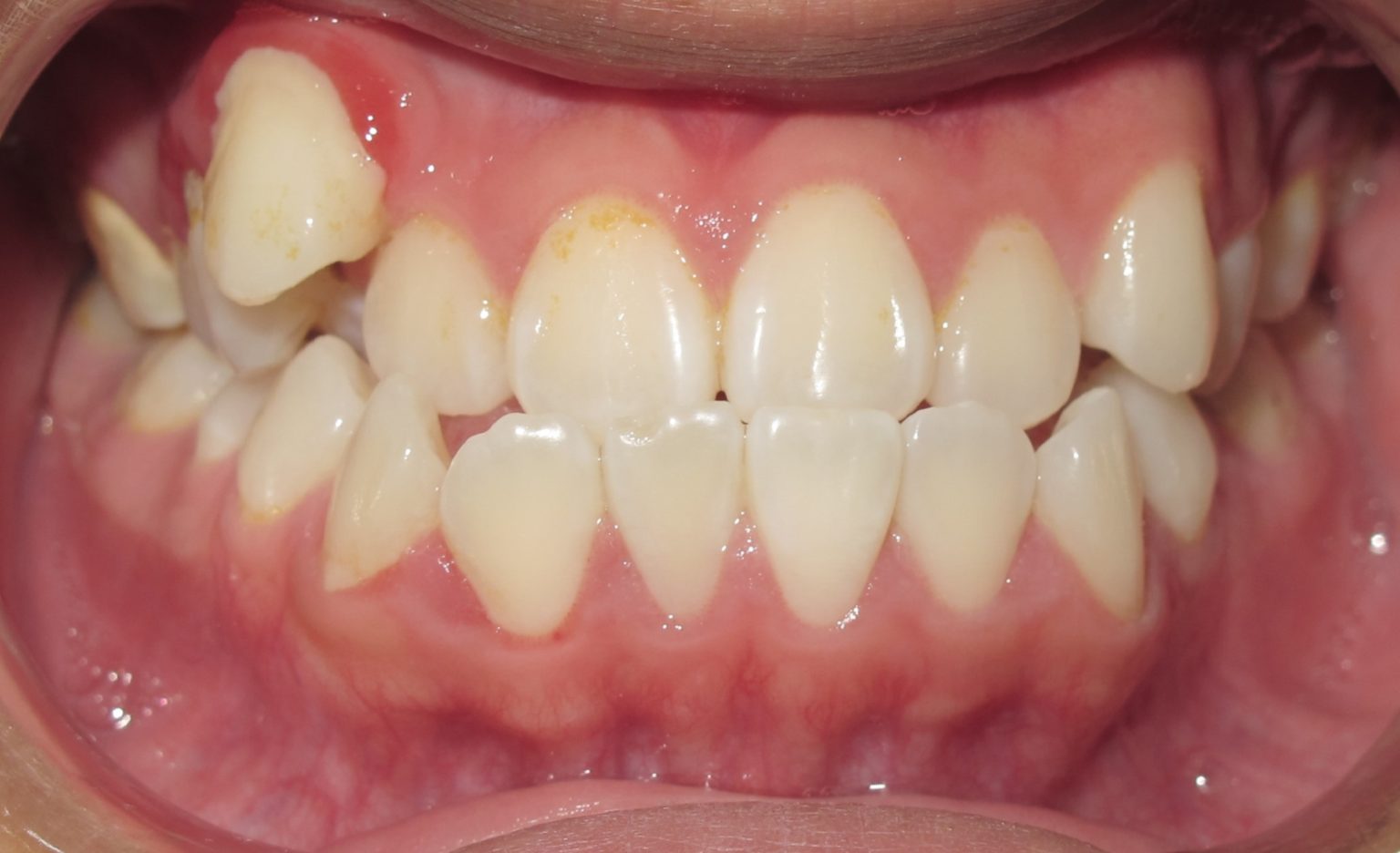 How Do Braces Fix Underbites? Premier Orthodontics