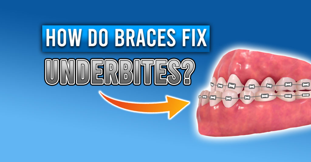 how do braces fix underbites