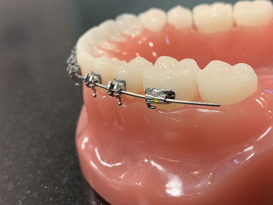 Broken Brackets What You Need To Know Premier Orthodontics 