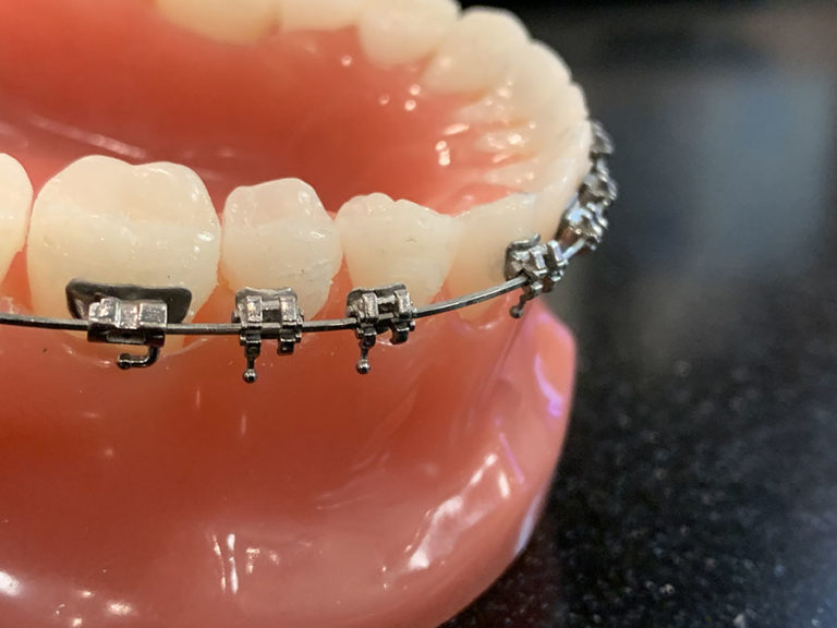 Broken Brackets What You Need to Know Premier Orthodontics