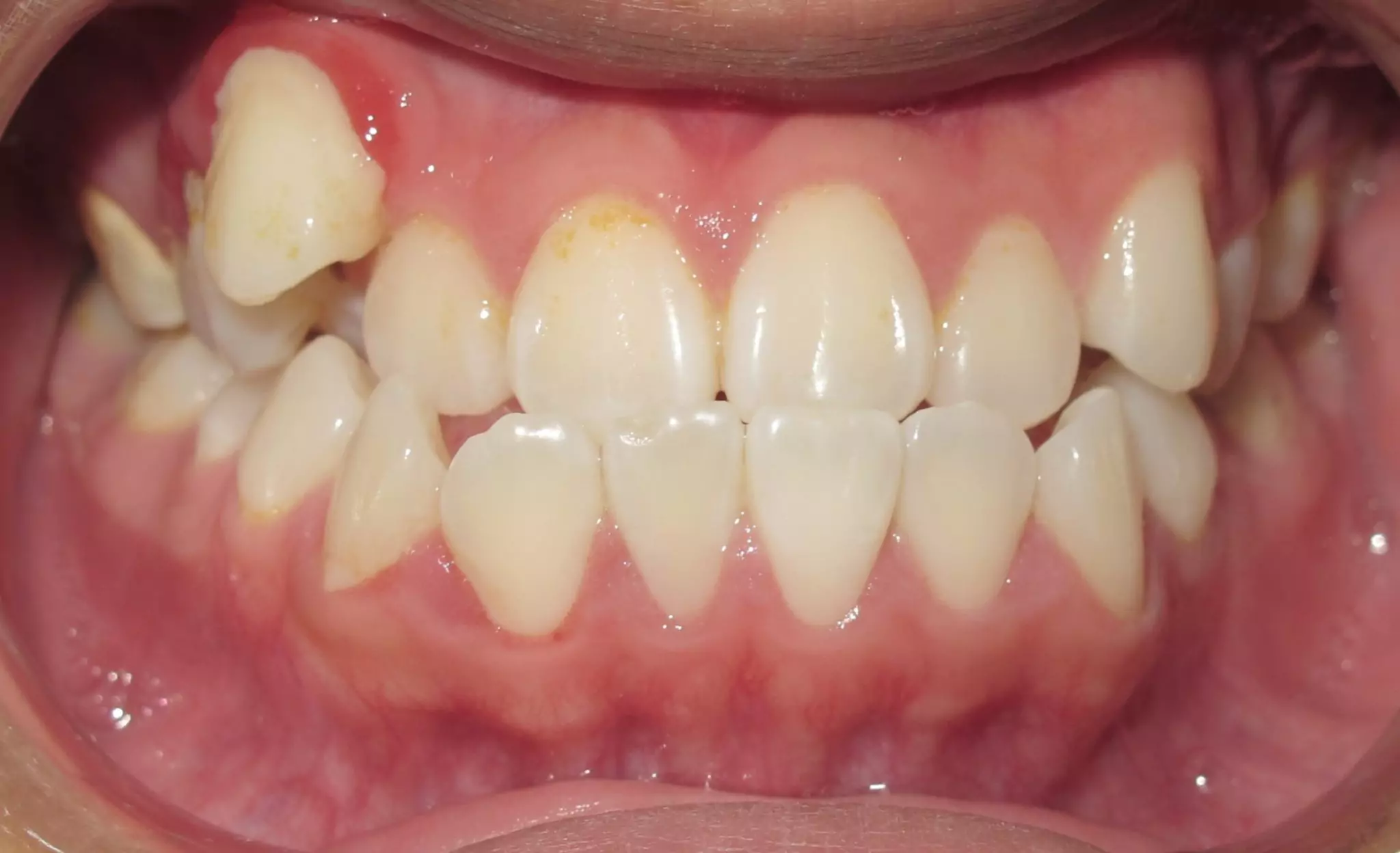 patient-with-a-mild-underbite-anterior-before-photo