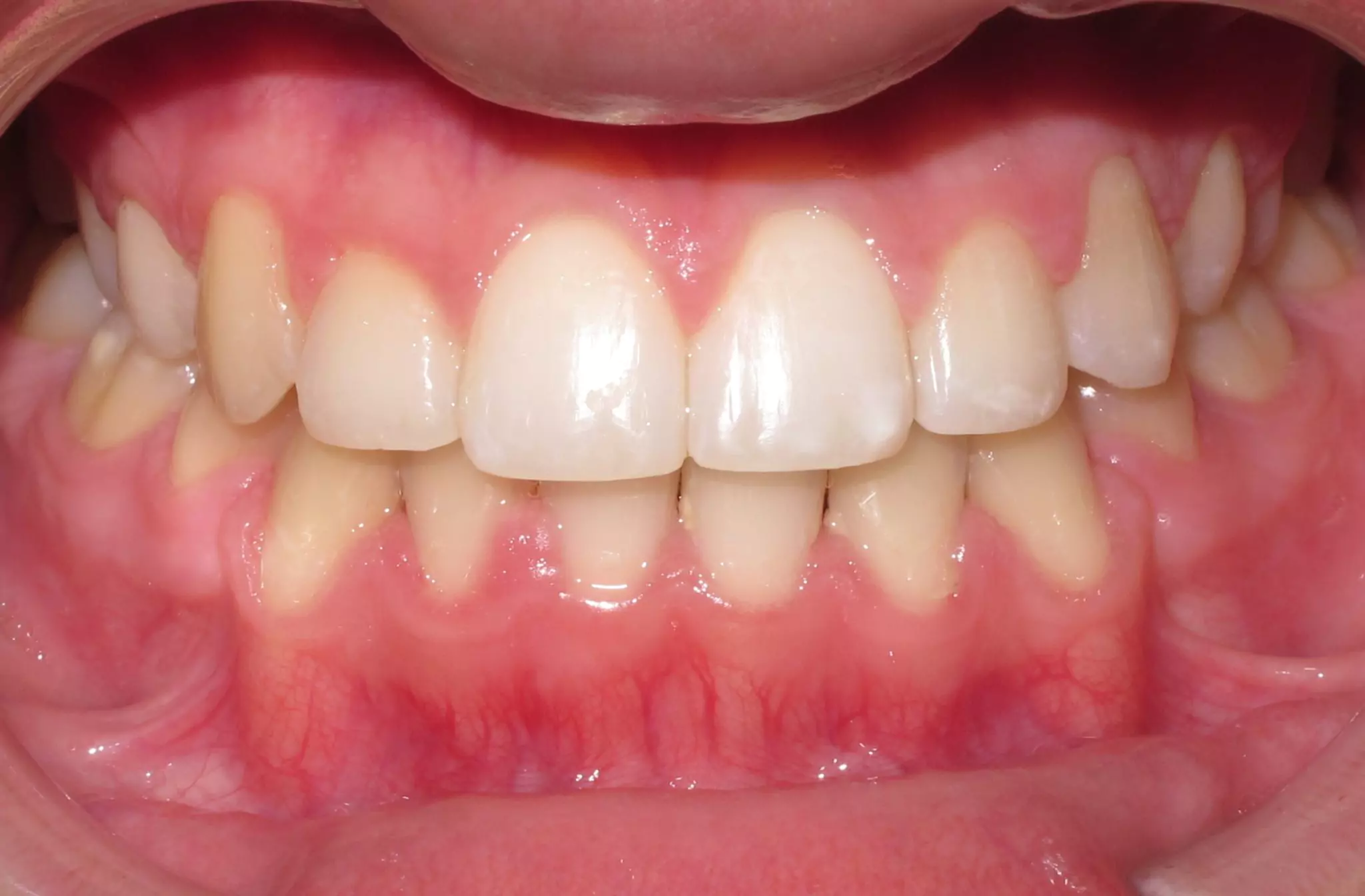 patient-with-a-moderate-underbite-anterior-after-
