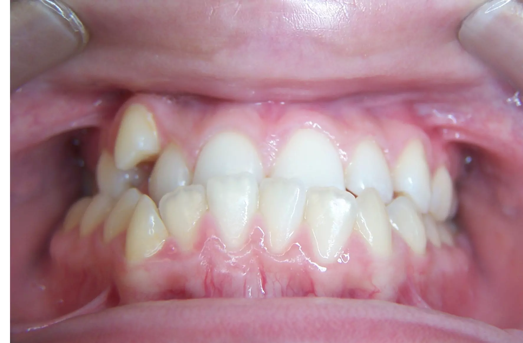 patient-with-a-moderate-underbite-anterior-before-photo