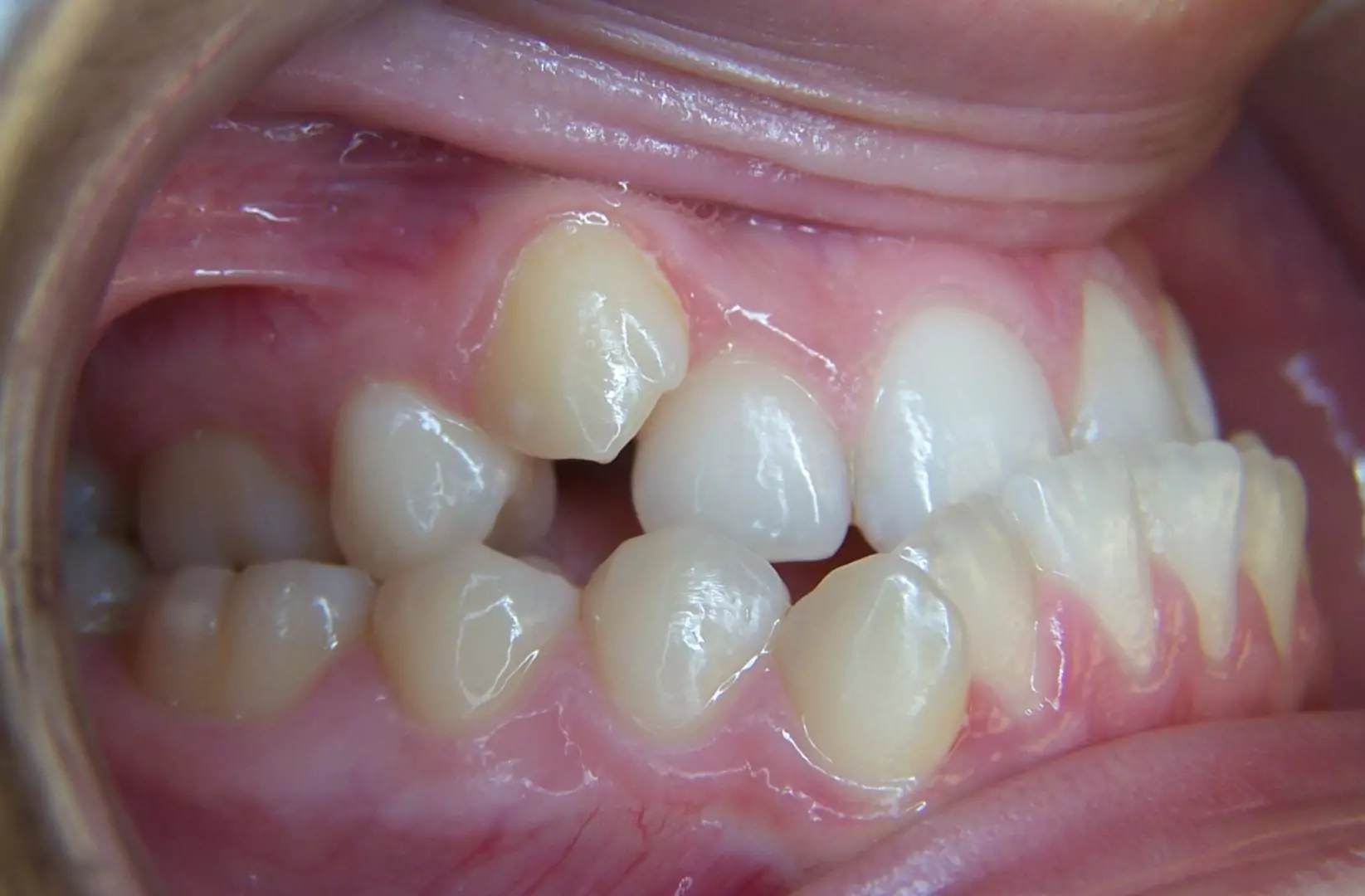 patient-with-a-moderate-underbite-lateral-before-