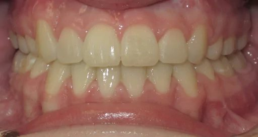 patient-with-a-severe-underbite-anterior-after