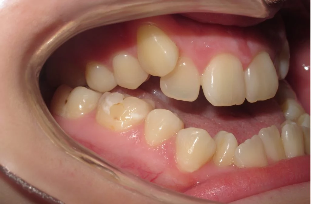 patient-with-a-severe-underbite-lateral-before-photo