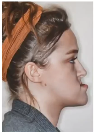 patient-with-a-severe-underbite-lateral-facial-photo-before