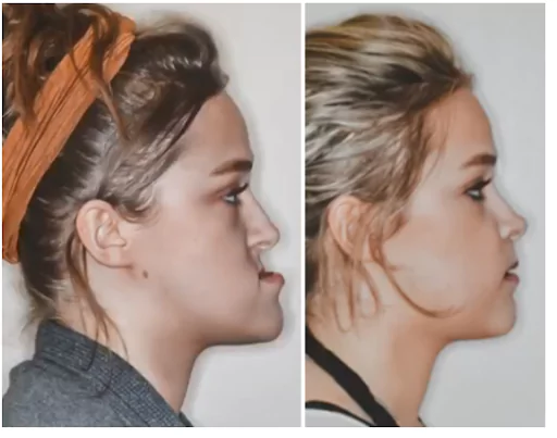 severe-underbite-before-and-after