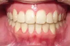 open bite after braces