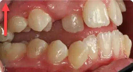 molar intrusion, movement helped to fix dental problems including open bites and often gummy smile