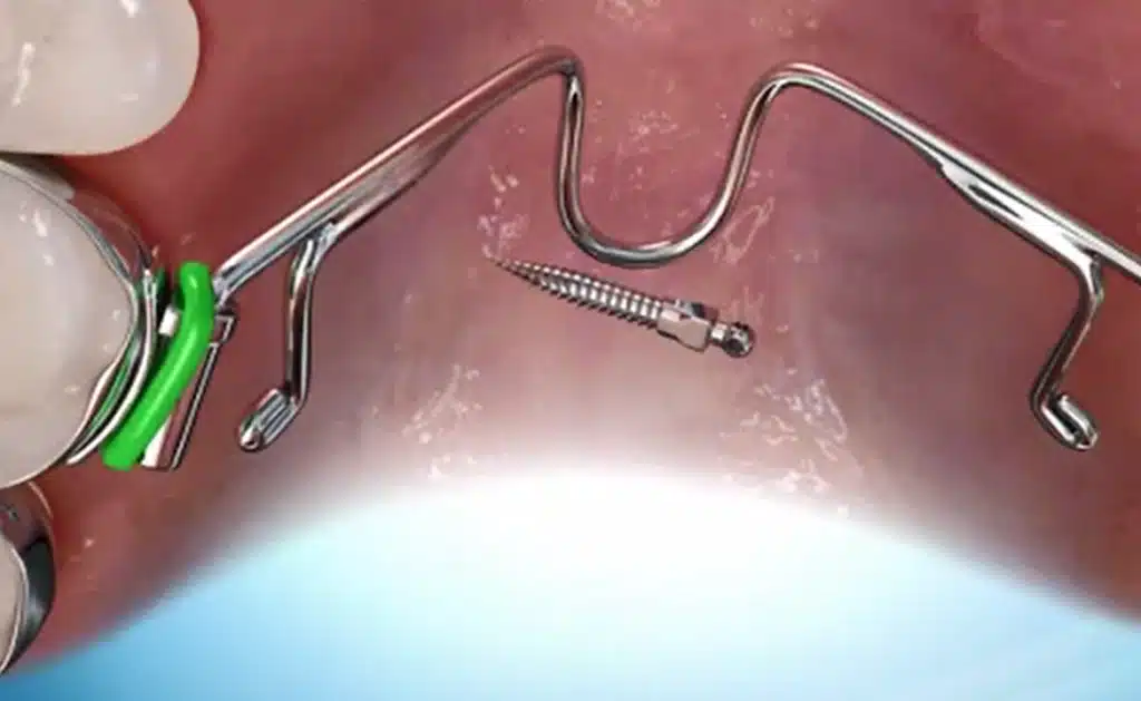 TAD screw and orthodontic appliances used to correct open bite malocclusions. The TADS are placed in the oral cavity