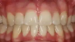 open bite after braces