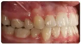 Anterior Open Bite Malocclusion after braces