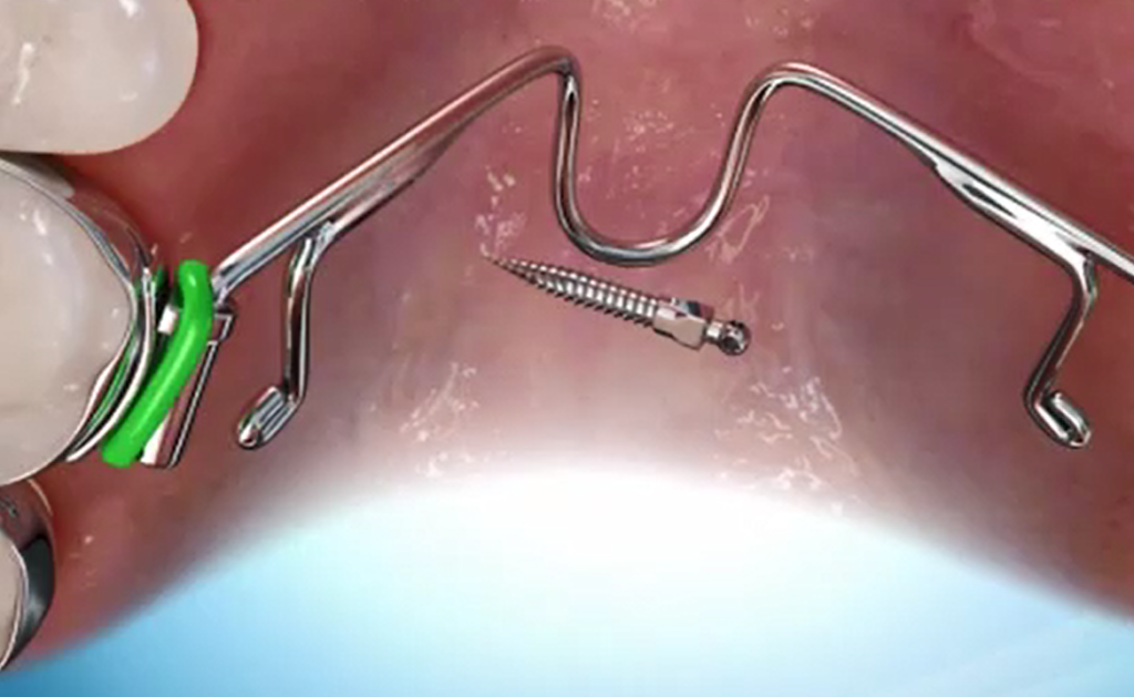 TAD screw