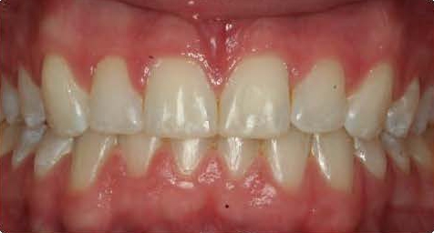 ideal overbite